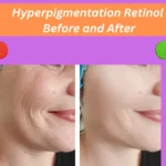 Hyperpigmentation Retinol Before and After