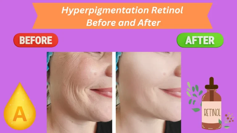 Hyperpigmentation Retinol Before and After