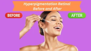 Hyperpigmentation Retinol Before and After