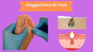 Clogged Pore On Foot