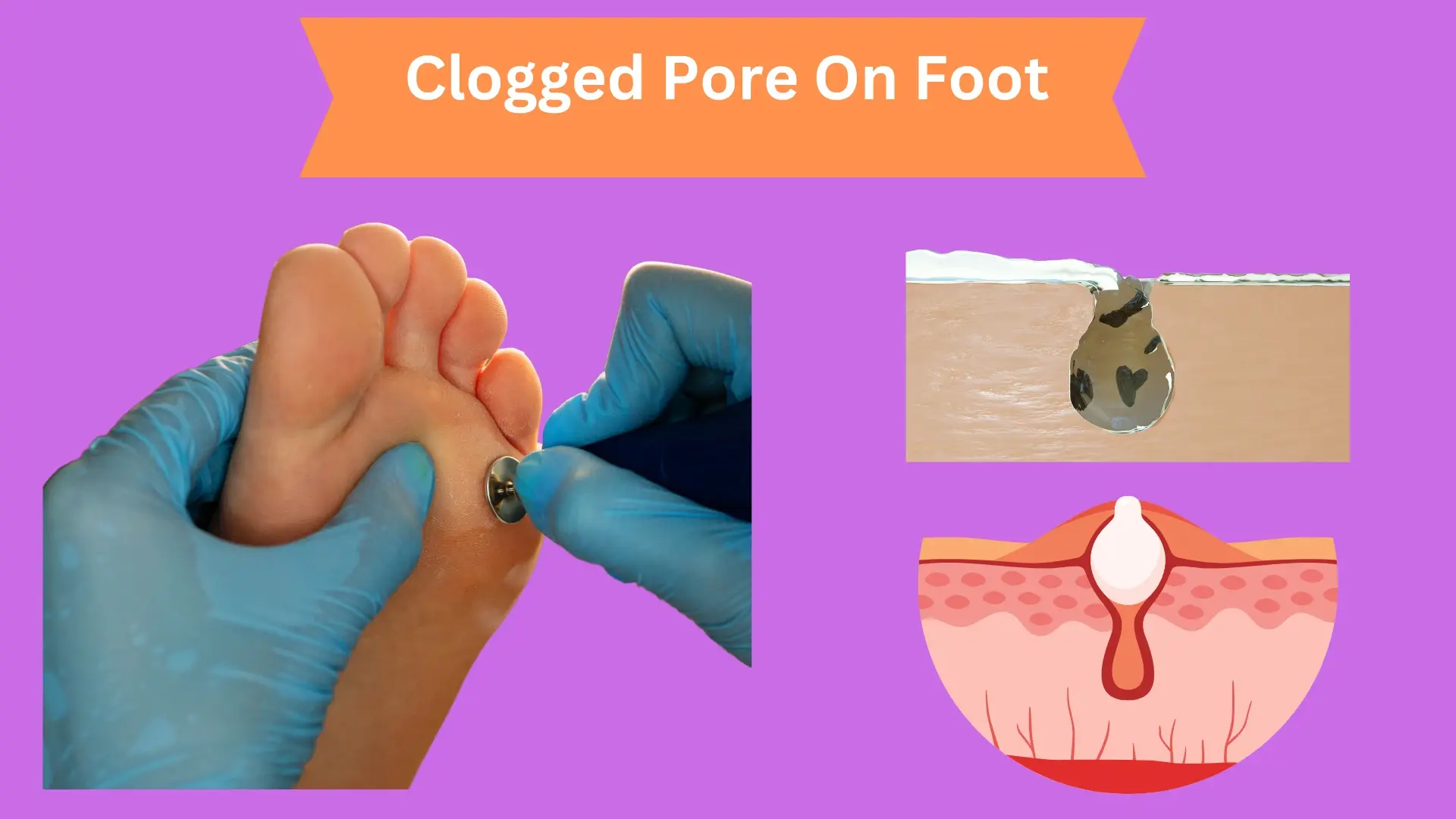 Clogged Pore On Foot